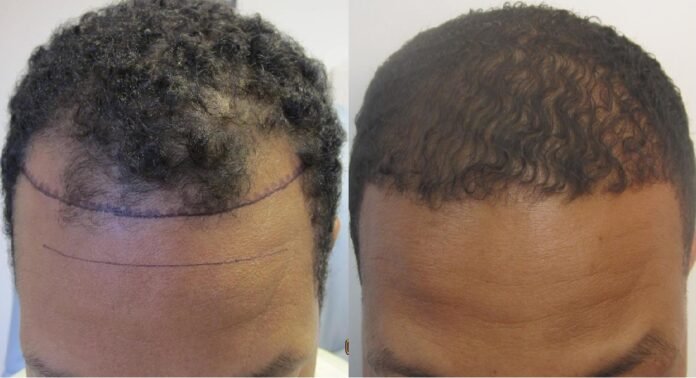 Textured Hair Transplant Cost
