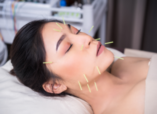 All about Acupuncture in Sherwood Park and it’s Benefits