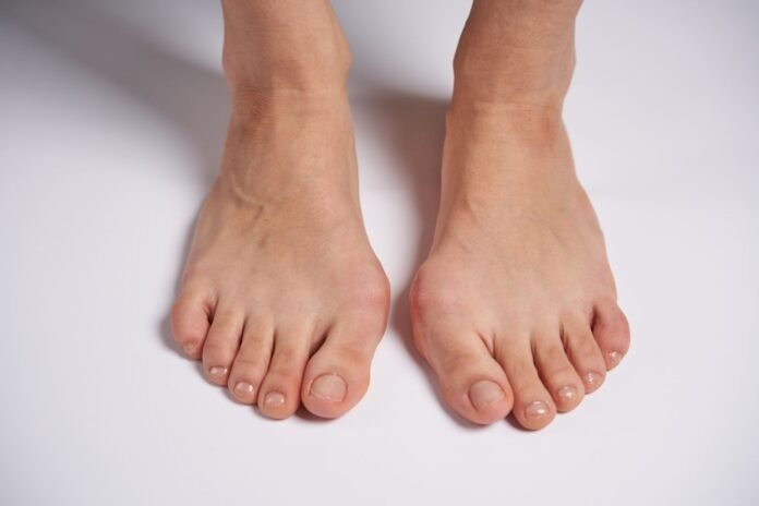 bunion treatment