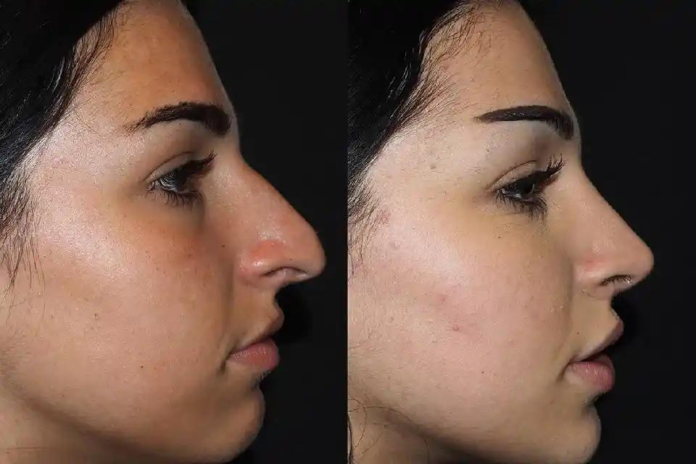 rhinoplasty in dubai