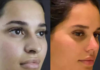 Rhinoplasty for Teenagers: When Is the Right Time?