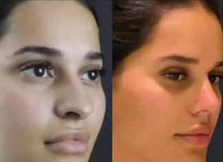 Rhinoplasty for Teenagers: When Is the Right Time?